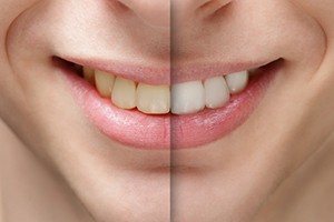 Before and After Teeth Whitening