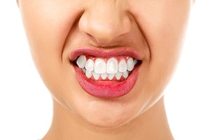 Woman with Bruxism